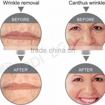 Skin Tightening Beauty Machine OD-R105 Face Lifting Portable rf Radio Frequency Facial Machine for Home Use photo-5