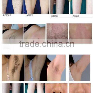 Portable CE Approved Laser Diodo 808nm Salon Hair Removal Machine/permanent Alexandrite Unhairing Laser