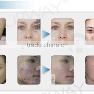 Laser Hair Removal Fda Approved Ipl Laser Machine photo-2