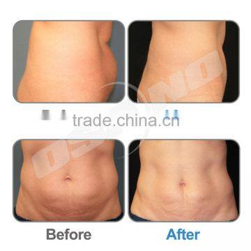 Vacuum Fat Loss Machine Vela Slimming Velahsape II Ultrasonic Cavitation Radio Frequency Weight Loss Machine Body Cavitation Machine photo-6