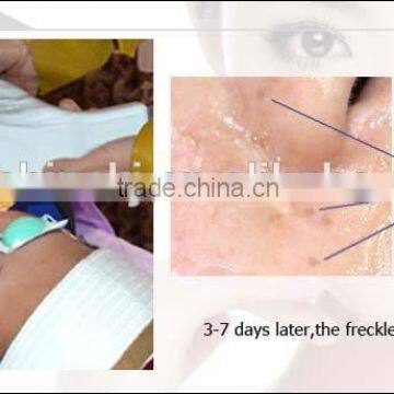 Best Facial Removal Salom Beauty Machine With Beauty Energy Bar photo-5