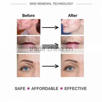 2016 Newest 4 in 1 Derma Roller 300 720 1200 Needles Stainless Micro Needle Therapy Derma Roller Dermaroller Anti Wrinkle Creme photo-5