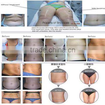 Best Quality New Coming 50 / 60Hz 2016 Cryolipolysie Machine Cellulite Reduction photo-5