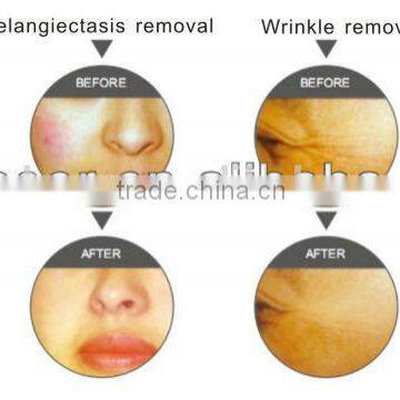 Beauty Equipment With IPL System to Remove Pore,acne, Wrinkles, Freckles photo-2