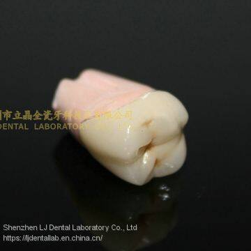 Dental Crown 3M Lava Zirconia, Dental Teeth, Dental Prosthesis, Laboratoire Dentaire, Dentallabor, Laboratorio Dental, Dental Laboratory, Shenzhen LJ Dental Lab China photo-2