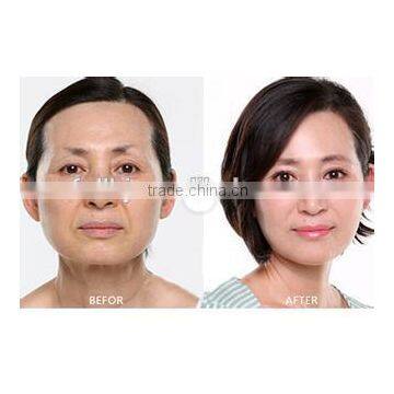 The Most Impressive Safe Beauty Therapy Radio Frequency For Home Use Portable Machine photo-5