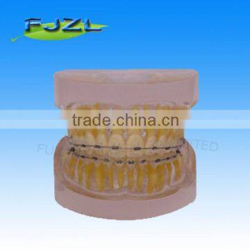 orthodontic teeth model(Transparent model , normal tooth, invisible brackets),dental orthodontic models