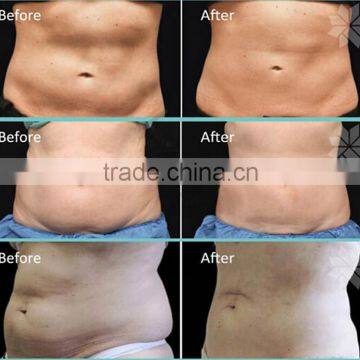 2017 Medical Safe and Comfortable Treatment Cryo 3 Handle , Cryo Fat Freeze Slimming Vacumm Fat Freezing Machine CL2 photo-6