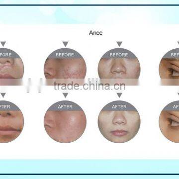 F5 Portable Style Fractional CO2 Laser With Cutting Probes for Skin Tag Removal photo-6