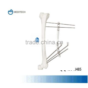 Dynamic External Fixator orthopedic surgical instruments