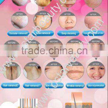 2016 New IPL Laser Hair Removal Machine photo-2