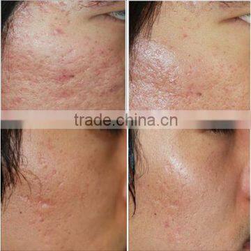 Radio Frequency Machine rf Price / Best rf Skin Tightening Face Lifting Machine Wanted