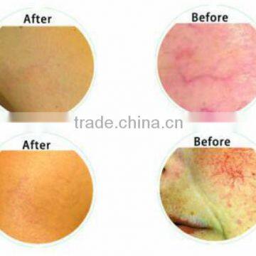 2016 Newest Invention 980nm Laser Spider Vein Removal, Blood Vessel Spider Vein Removal Machine photo-6