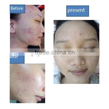 Oxygen Skin Care Machine Basic Skin Daily Care Water Oxygen Jet Peel Machine For Salon Private Beauty Center Dispel Chloasma photo-5