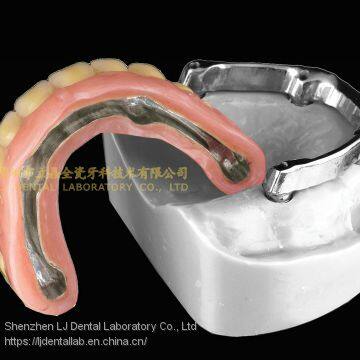 Dental Implant Bar, Implant Overdenture, Implant Prosthesis, Laboratoire Dentaire, Dentallabor, Laboratorio Dental, Dental Laboratory, Shenzhen LJ Dental Lab China photo-4