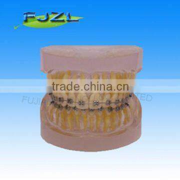 orthodontic teeth model(Transparent model , normal tooth, common brackets)/dental orthodontic models