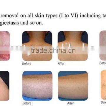 Pain-Free 808nm Diode Laser Hair Removal Machine Portable Whole Body