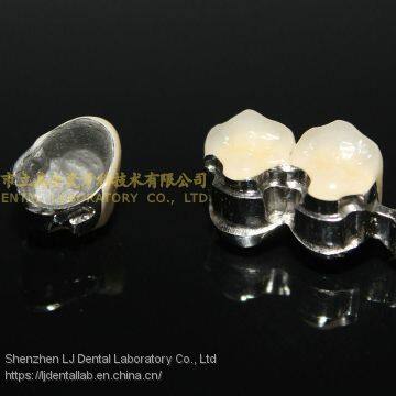 Dental Precision Attachment, Dental Attachment, Dental Denture, Laboratoire Dentaire, Dentallabor, Laboratorio Dental, Dental Laboratory, Shenzhen LJ Dental Lab China photo-3