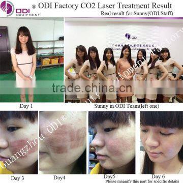 Eye Wrinkle / Bag Removal Website RF Excited Co2 Fractional Wart Removal Laser Machine For Skin Resurfacing (OD-C600) photo-4