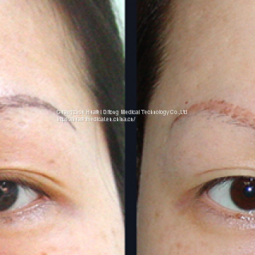 Portable Q Switch ND YAG Laser /Skin photo-4