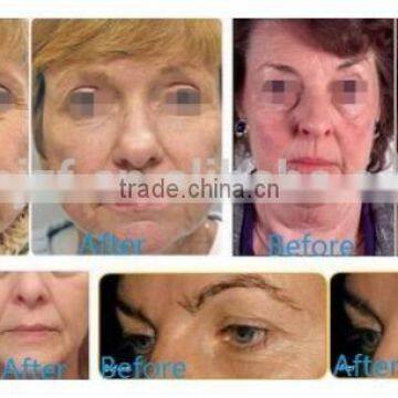 7 Head Hifu Wrinkle Deep Wrinkle Removal Removal Machine From Anybeauty Skin Tightening