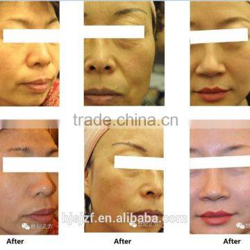 HIFU-C Professional Hifu Wrinkle Skin Tightening Removal Machine Face Lift 8MHz