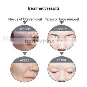 2016 New Products Looking for Distributors 532nm 1320nm 1064nm q Switched nd Yag Tattoo Removal Machine photo-5