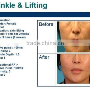 TaiBo Beauty Advanced Beauty Medical Fractional rf Machine High Frequency Wrinkle