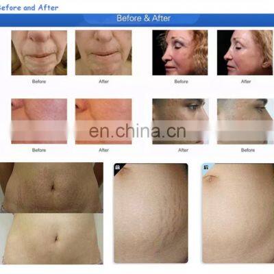 Sales ce New Type 4 In1 Dermaroller,beauty Face Roller,dema Roller Skin Care photo-3