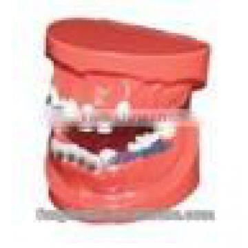 Orthodontics treatment model AC-P17