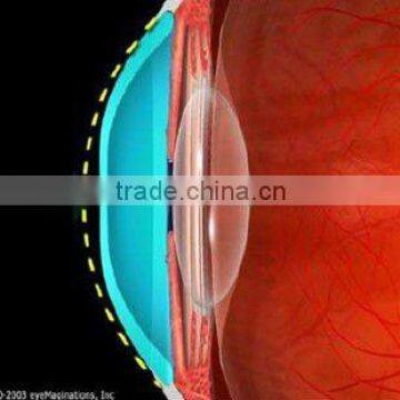 Digital Rigid contact lens for corneal reshape / MCT/ Luxuriant metamorphosis of RGP Lenses