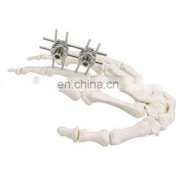 CE & ISO Marked Mini Fragment External Fixator Orthopedic Surgical Implant