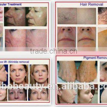 590-1200nm Home Use Mini Hair Removal Machine/laser 560-1200nm Ipl Hair Removal Machines Acne Removal