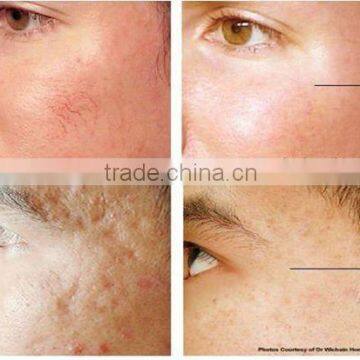 The Radio Frequency Scarlet Fractional rf Mini Portable Facial Equipment photo-6