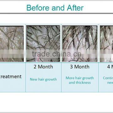 650nm Diode Laser Hair Growth Machine for Sale/Laser Hair Loss Treatment/ Collagen Hair Treatment photo-6