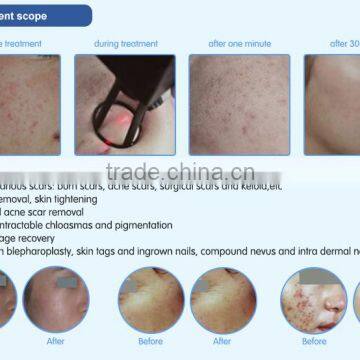 Most Advanced High Quality Beauty Equipment 10600 nm Laser Co2 Surgical Laser With USA Tube photo-5