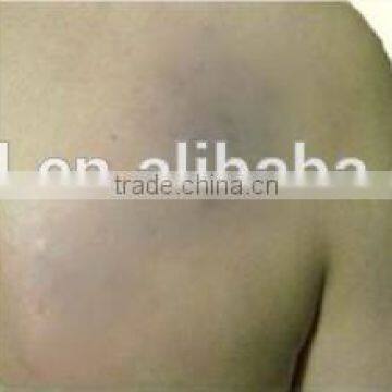 Machine For Small Business Rotary Machine For Tattoo Removal Freckles Removal Q Switch ND Yag Laser Yag 1000 Tattoo Removal Telangiectasis Treatment photo-4