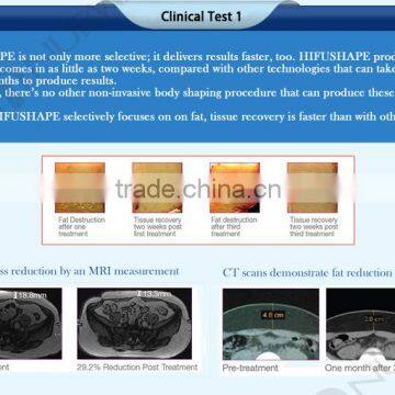 Nasolabial Folds Removal Amazing Slim 2016 Beauty Salon Use Hifu For Expression Lines Removal Body / High Intensity Focused Ultrasound Hifu/hifu Korea Machine With CE photo-5