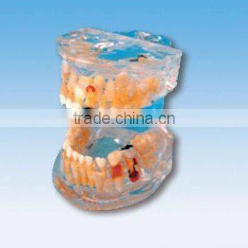 Transparent model for the pathology of baby teeth