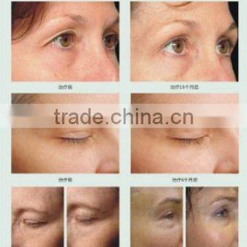 AYJ-C19(CE) Dot Matrix Portable rf Thermagic Galvanic Facial Machine photo-6