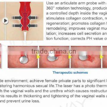 Vaginal Tighten Fractional Co2 Laser Vaginal Tightening photo-4