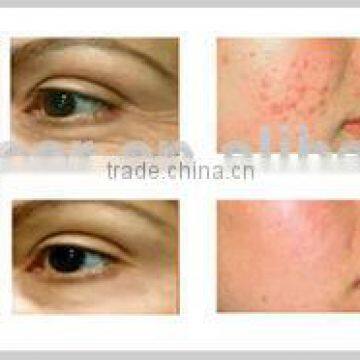 YUWEI Portable Medical Face Lift Scar Removal Machine With Micro Needle RF photo-3