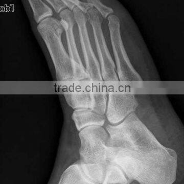 China KND-A/F CE medical dry film radiografia de pie derecho
