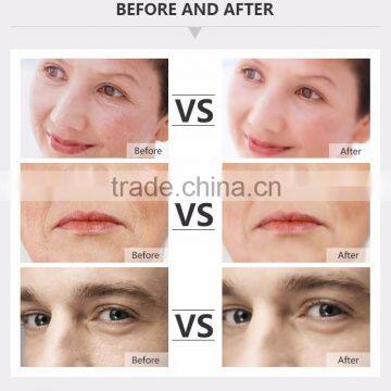 RF Anti Aging Skin Treatment Skin Rejuvenation Equipment photo-6