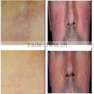 TOP 1 Sale!!! Immediately Results High Frequency Spider Vein Removal Machine Removal of Skin Tags photo-6