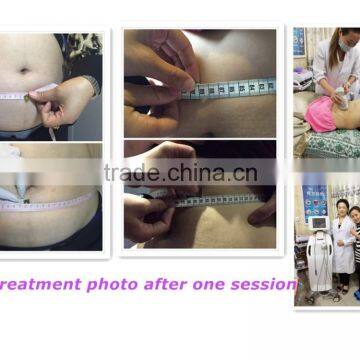 Non-surgical Treatment Slimming Liposonix Body Shaping Machine photo-6