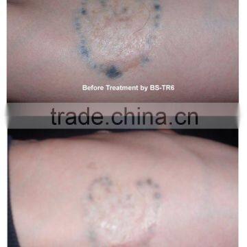 1-10Hz E-light IPL Rf Nd Yag Laser / Multifunction Machine Nd Yag Laser Freckles Removal photo-3