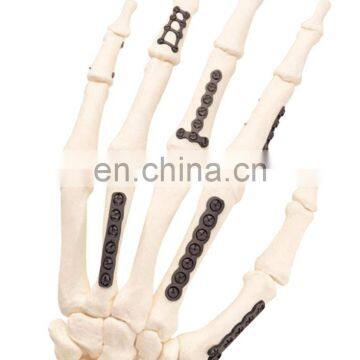 Orthopedic Plates for Fixation of Mini Bone Fractures photo-2