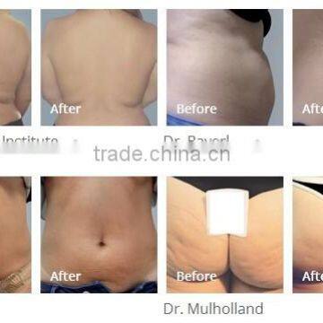 Body Shaping Radiofrequency Machine
