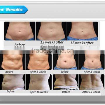 Increasing Muscle Tone Cryolipolysis Body Cool Shape Keyword Cryolipolysis Cryotherapy Slimming Machine Beauty Machine For Slimming Cryolipolysis Slimming Machine photo-5